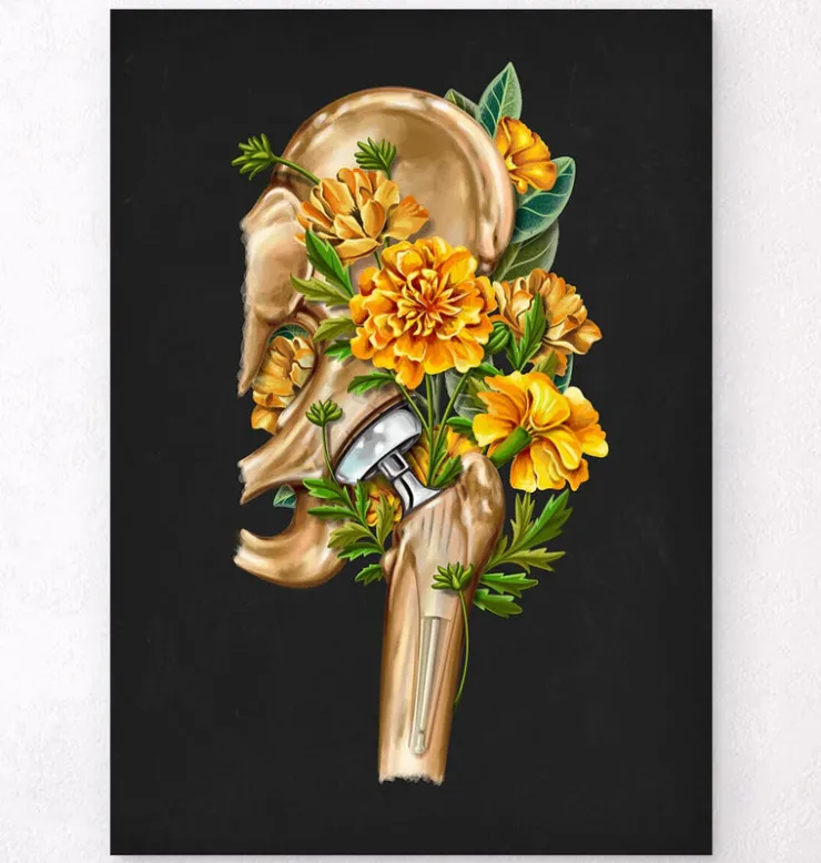 Prothèse totale de hanche - Floral - Noir-Codex Anatomicus Clearance